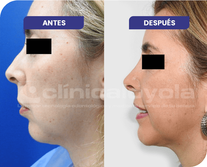 2024_Oct_CasoExito_2_Rinoplastia_Mentoplastia