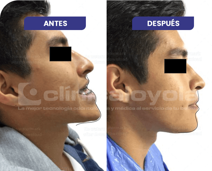 2024_Oct_CasoExito_6_Cirugia_Ortognatica_Maxilar