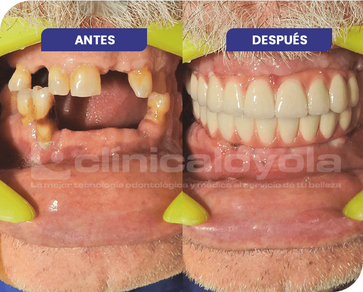 Detalle implantes dentales antes y después - Clínica Loyola
