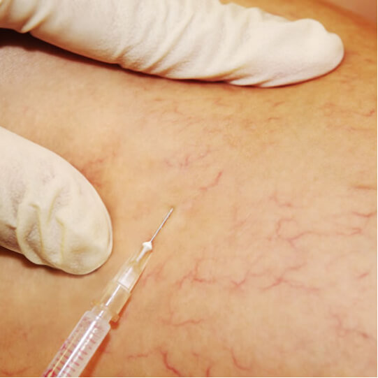 Primer plano escleroterapia