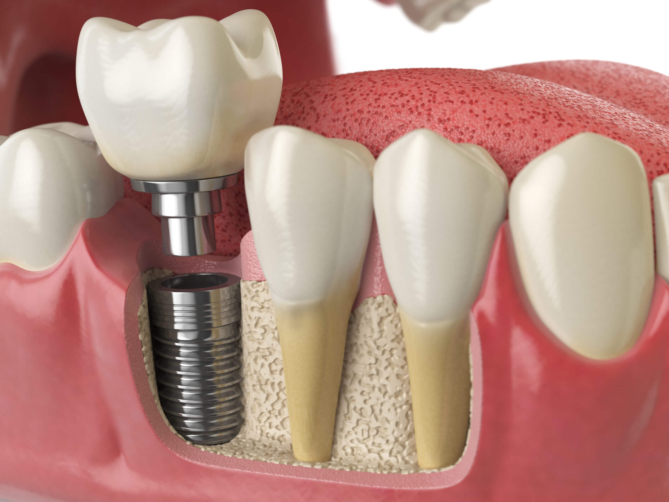 procedimiento de implantes dentales