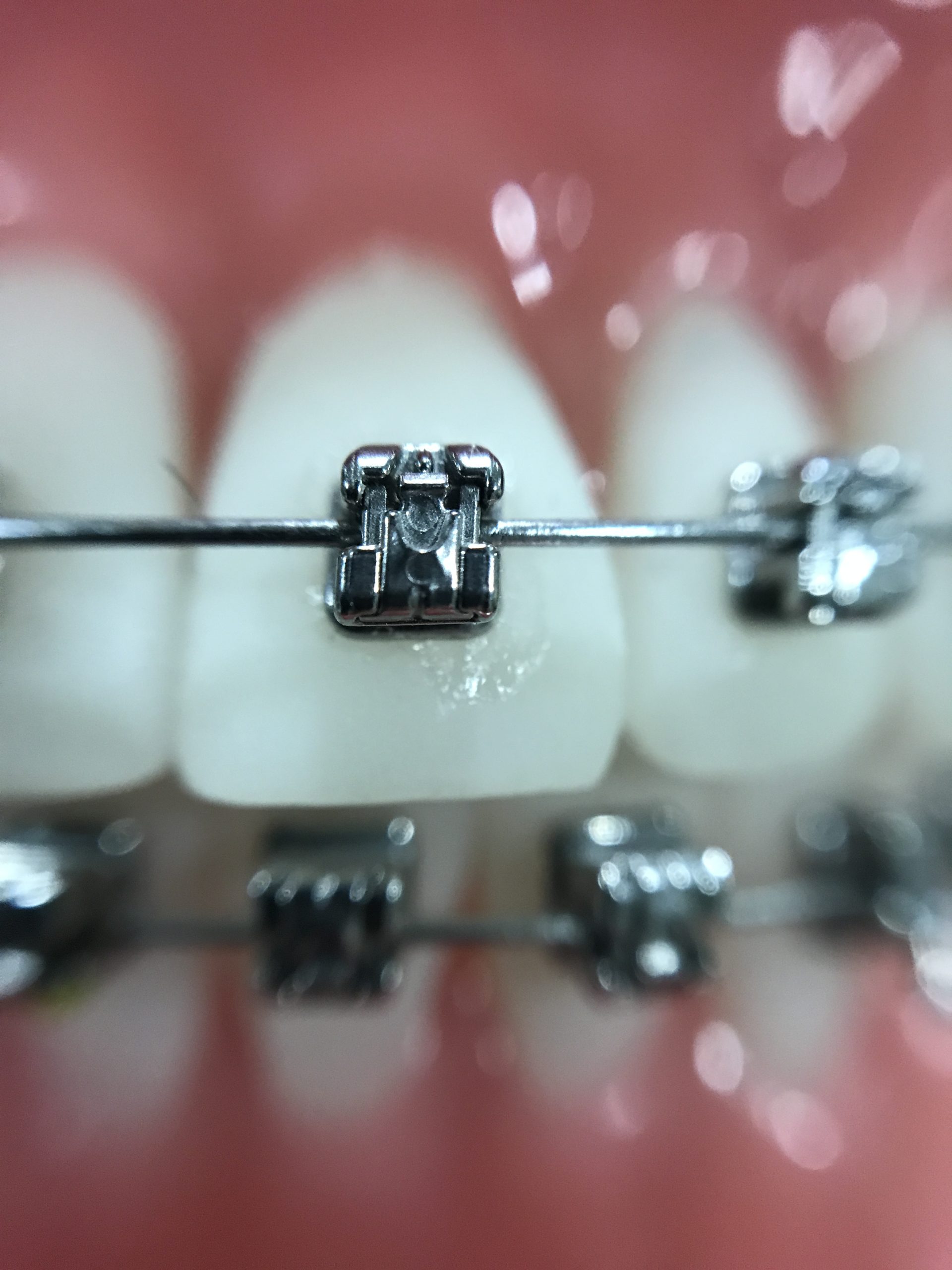 Primer plano de tratamiento de ortodoncia