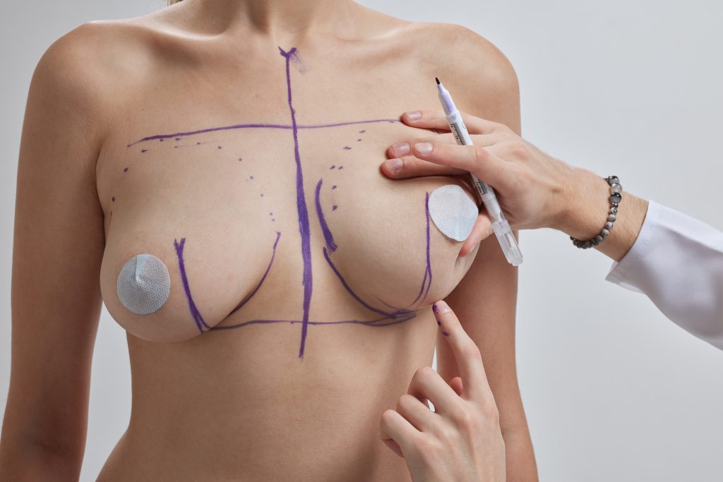 Evaluación mastopexia en senos