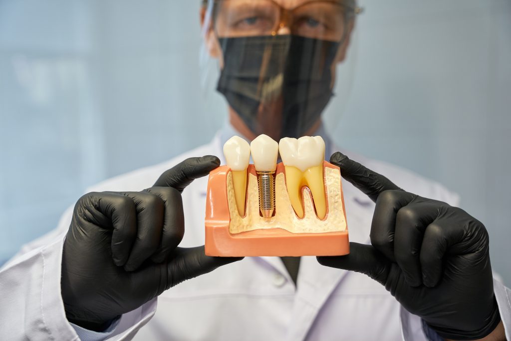 implantes dentales