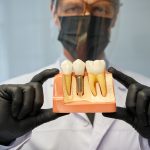 implantes dentales
