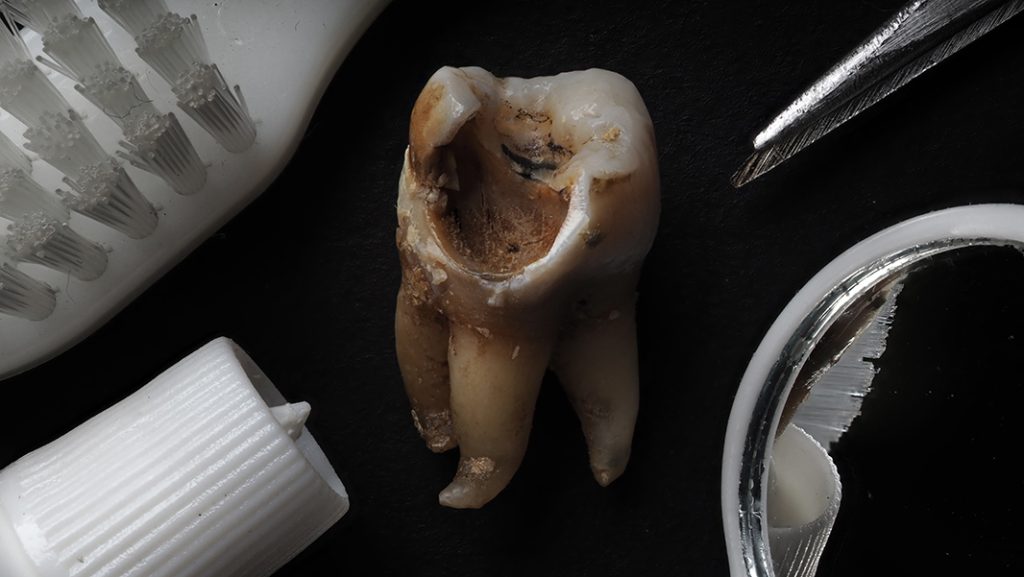 muela con caries
