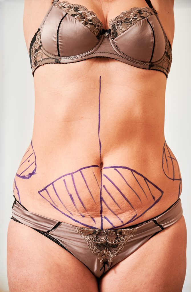 análisis de grasa en el abdomen
