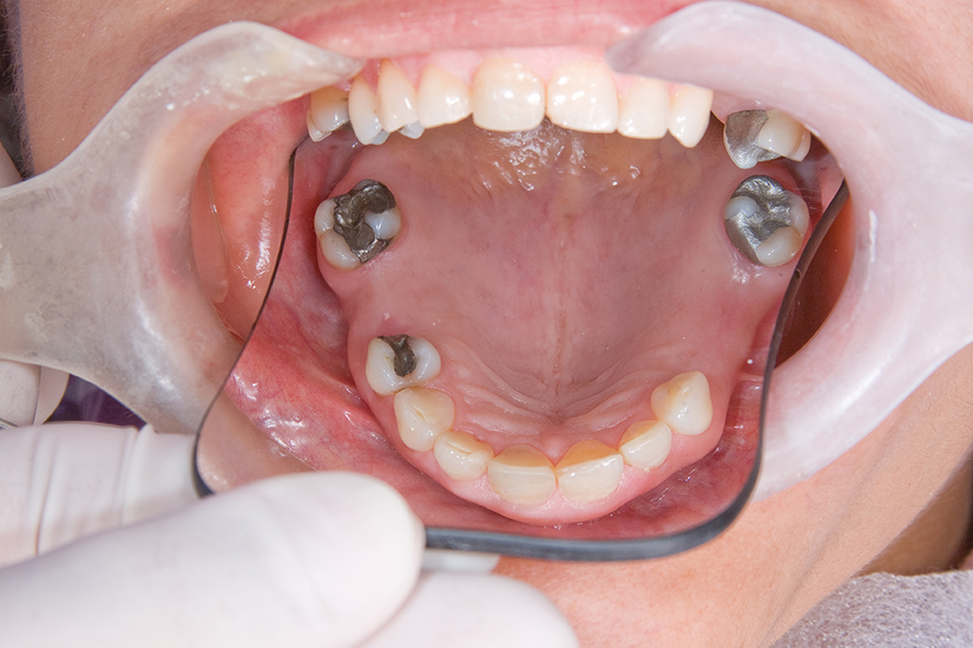 boca previo a implantes dentales