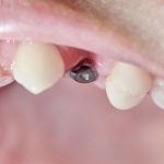 implante dental real