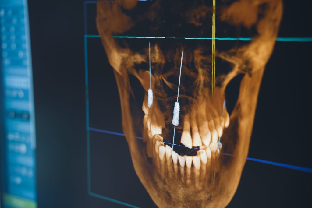 Evaluación del hueso antes de un implante​ dental