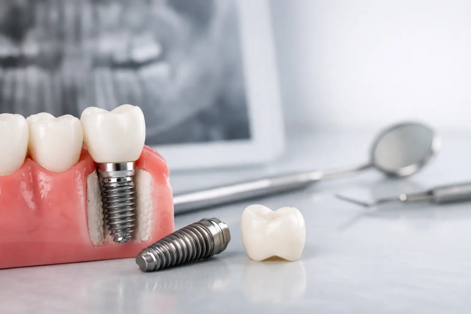 Implantes dentales: cuándo son la mejor opción
